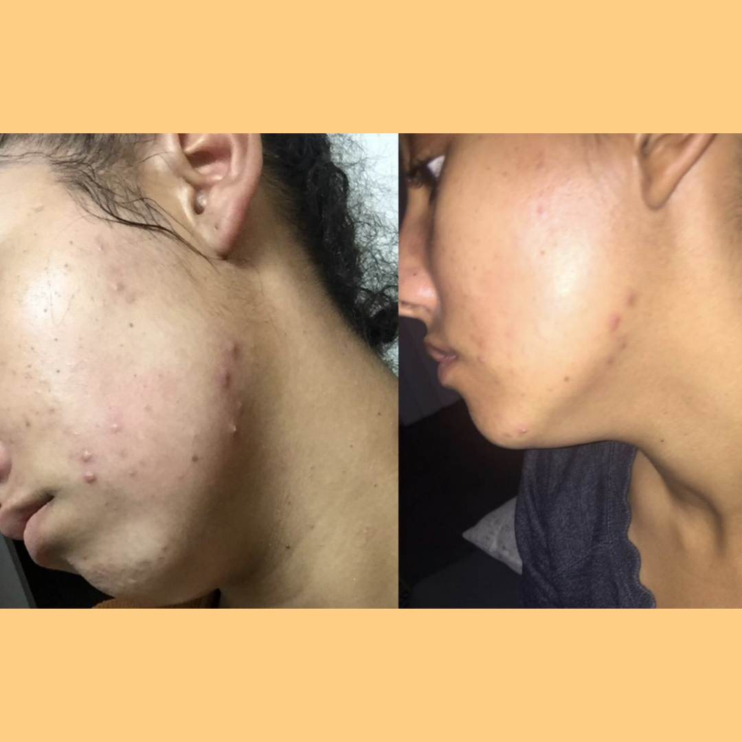 Hembes turmeric skincare products. How to clear skin. Turmeric Skincare. Face wash gel. Face wash. Soap. Turmeric soap. Turmeric. Vitamin c face wash . Face wash. Turmeric face wash gel. Natural skincare products. How to treat acne. How to get rid of dark spots. Dark spots. Acne spots. Pimples. Skincare routine. Glowing skin. Healthy skin. Sensitive skin. Reduce fine lines. Reduce wrinkles. Even skin. Hydrate skin. Nourish skin. Dry skin. Oily skin. Combination skin. Anti-aging skincare