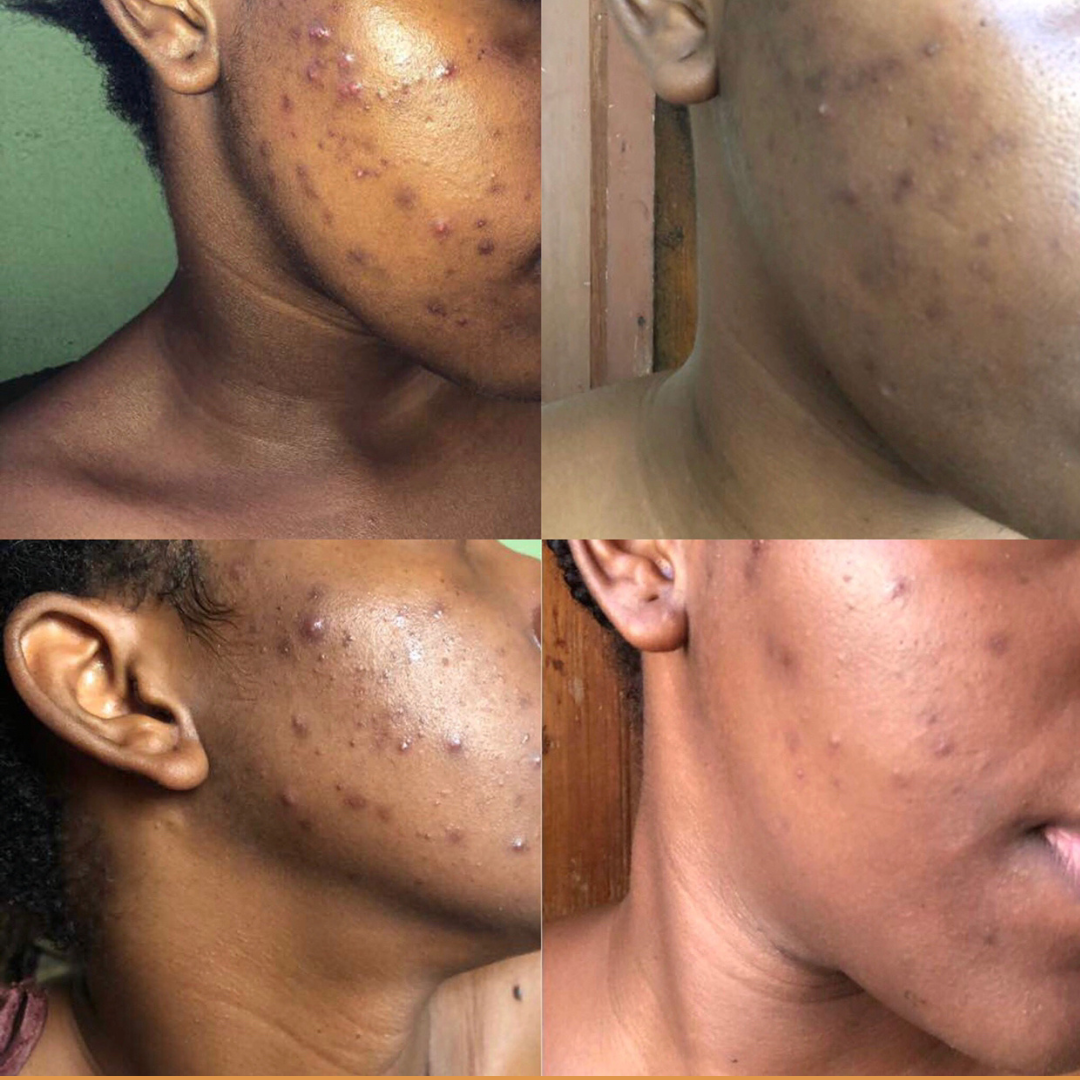 Hembes turmeric skincare products. How to clear skin. Turmeric Skincare. Face wash gel. Face wash. Soap. Turmeric soap. Turmeric. Vitamin c face wash . Face wash. Turmeric face wash gel. Natural skincare products. How to treat acne. How to get rid of dark spots. Dark spots. Acne spots. Pimples. Skincare routine. Glowing skin. Healthy skin. Sensitive skin. Reduce fine lines. Reduce wrinkles. Even skin. Hydrate skin. Nourish skin. Dry skin. Oily skin. Combination skin. Anti-aging skincare