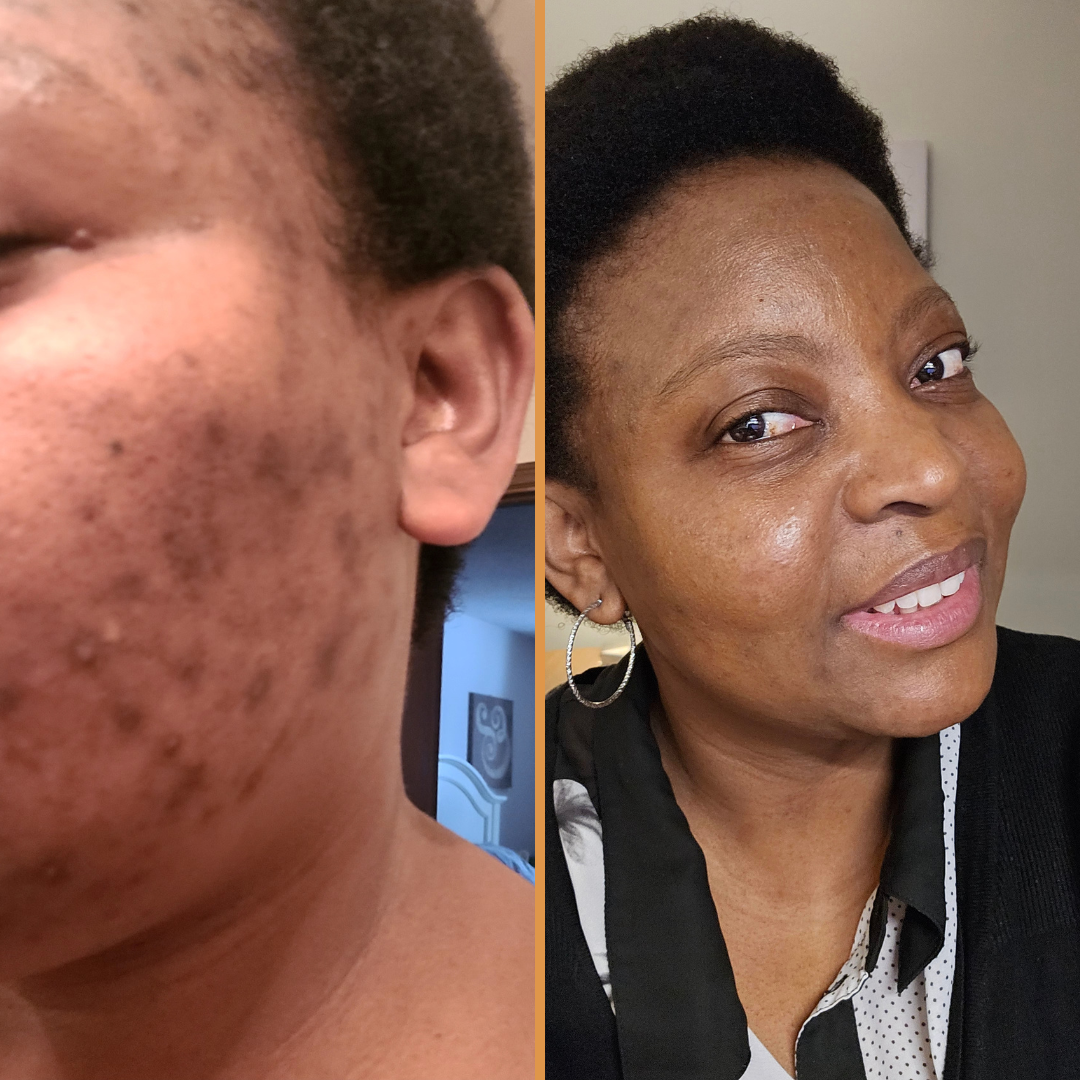 Hembes turmeric skincare products. How to clear skin. Turmeric Skincare. Turmeric face toner. Turmeric toner. Dark spot corrector. Natural skincare products. How to treat acne. How to get rid of dark spots. Dark spots. Acne spots. Pimples. Skincare routine
