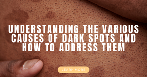 Understanding the Various Causes of Dark Spots and How to Address Them