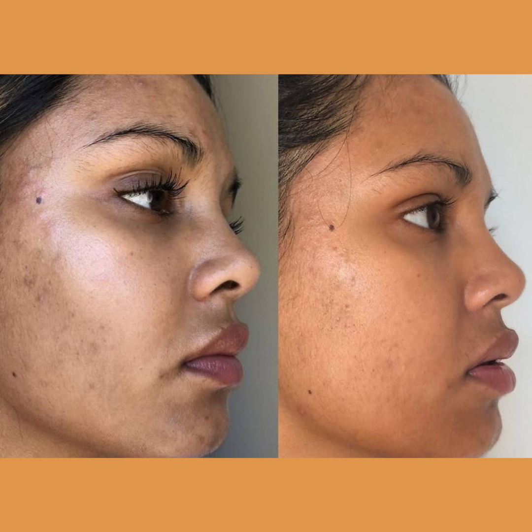 Hembes turmeric skincare products. How to clear skin. Turmeric Skincare. Face wash gel. Face wash. Soap. Turmeric soap. Turmeric. Vitamin c face wash . Face wash. Turmeric face wash gel. Natural skincare products. How to treat acne. How to get rid of dark spots. Dark spots. Acne spots. Pimples. Skincare routine. Glowing skin. Healthy skin. Sensitive skin. Reduce fine lines. Reduce wrinkles. Even skin. Hydrate skin. Nourish skin. Dry skin. Oily skin. Combination skin. Anti-aging skincare
