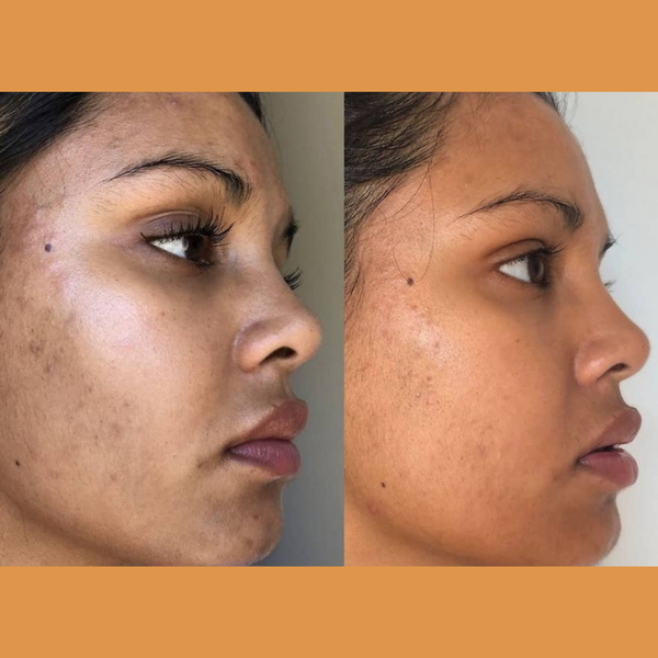 Hembes turmeric skincare products. How to clear skin. Turmeric Skincare. Face wash gel. Face wash. Soap. Turmeric soap. Turmeric. Vitamin c face wash . Face wash. Turmeric face wash gel. Natural skincare products. How to treat acne. How to get rid of dark spots. Dark spots. Acne spots. Pimples. Skincare routine. Glowing skin. Healthy skin. Sensitive skin. Reduce fine lines. Reduce wrinkles. Even skin. Hydrate skin. Nourish skin. Dry skin. Oily skin. Combination skin. Anti-aging skincare
