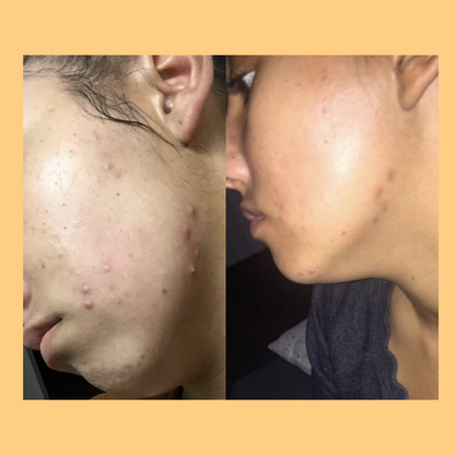 Hembes turmeric skincare products. How to clear skin. Turmeric Skin care sets. Face wash gel. Face toner. Turmeric soap. Turmeric face cream. facial moisturizers. Turmeric bar soap. Natural skincare products. How to treat acne. How to get rid of dark spots. Dark spots. Acne spots. Pimples. Skincare routine. Glowing skin. Healthy skin. Sensitive skin. Reduce fine lines. Reduce wrinkles. Even skin. Hydrate skin. Nourish skin. Dry skin. Oily skin. Combination skin. Anti-aging skincare