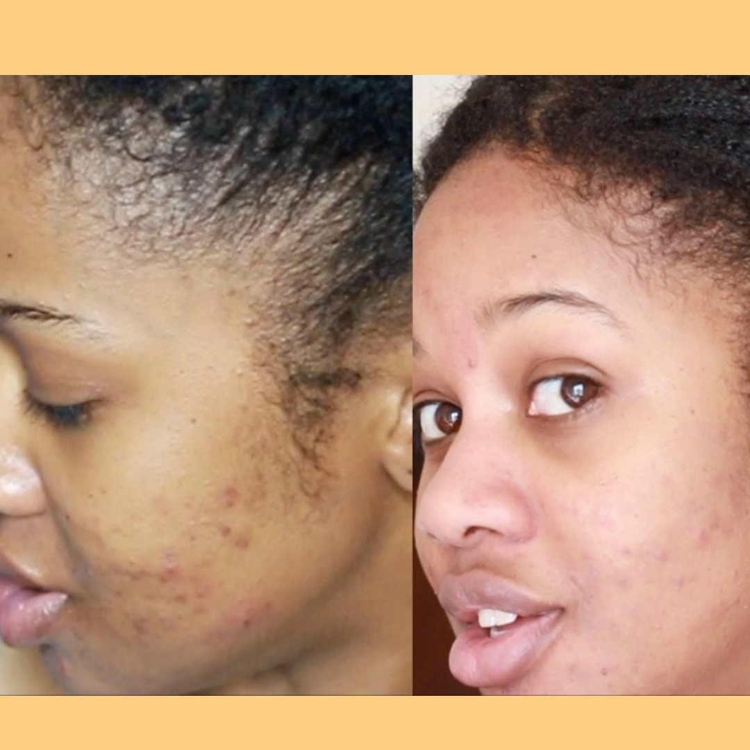 Hembes turmeric skincare products. How to clear skin. Turmeric Skincare. Full skincare set. Skincare routine set. Skincare collection. Face moisturizer. Face wash. Turmeric serum. face cream.Natural skincare products. How to treat acne. How to get rid of dark spots. Dark spots. Acne spots. Pimples. Skincare routine. Glowing skin. Healthy skin. Sensitive skin. Reduce fine lines. Reduce wrinkles. Even skin. Hydrate skin. Nourish skin. Dry skin. Oily skin. Combination skin. Anti-aging skincare