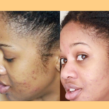 Hembes turmeric skincare products. How to clear skin. Turmeric Skincare. Full skincare set. Skincare routine set. Skincare collection. Face moisturizer. Face wash. Turmeric serum. face cream.Natural skincare products. How to treat acne. How to get rid of dark spots. Dark spots. Acne spots. Pimples. Skincare routine. Glowing skin. Healthy skin. Sensitive skin. Reduce fine lines. Reduce wrinkles. Even skin. Hydrate skin. Nourish skin. Dry skin. Oily skin. Combination skin. Anti-aging skincare