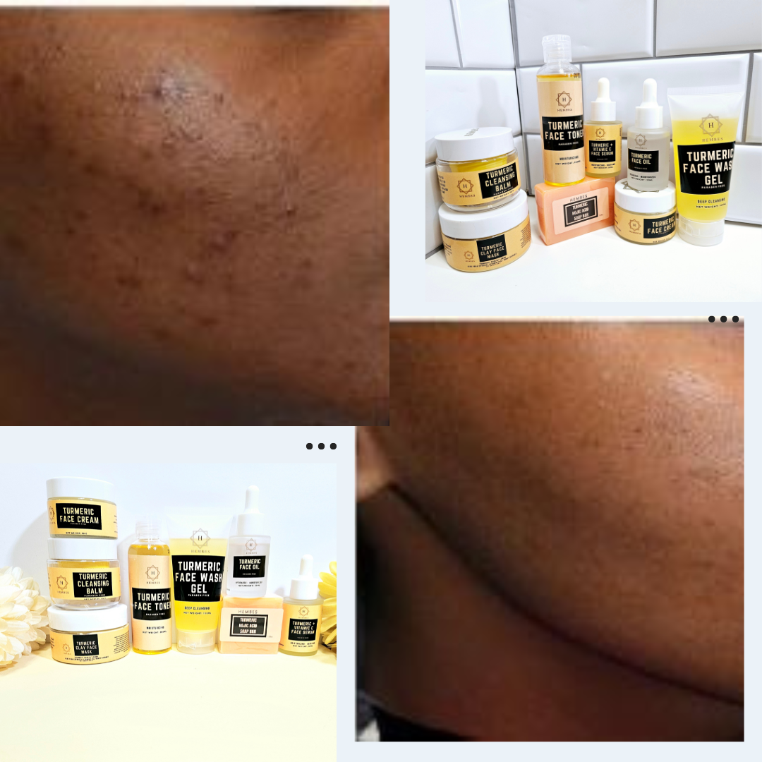 Hembes turmeric skincare products. How to clear skin. Turmeric Skincare. Full skincare set. Skincare routine set. Skincare collection. Face moisturizer. Face wash. Turmeric serum. face cream.Natural skincare products. How to treat acne. How to get rid of dark spots. Dark spots. Acne spots. Pimples. Skincare routine. Glowing skin. Healthy skin. Sensitive skin. Reduce fine lines. Reduce wrinkles. Even skin. Hydrate skin. Nourish skin. Dry skin. Oily skin. Combination skin. Anti-aging skincare
