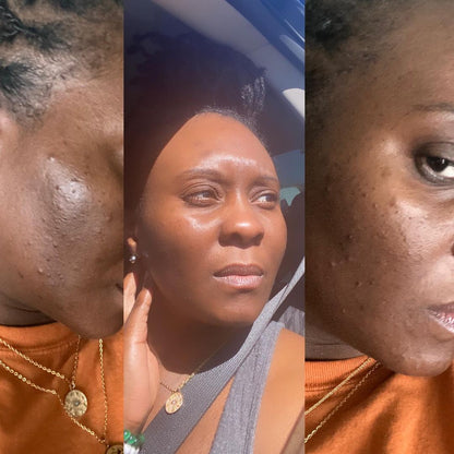 Hembes turmeric skincare products. How to clear skin. Turmeric Skincare. Full skincare set. Skincare routine set. Skincare collection. Face moisturizer. Face wash. Turmeric serum. face cream.Natural skincare products. How to treat acne. How to get rid of dark spots. Dark spots. Acne spots. Pimples. Skincare routine. Glowing skin. Healthy skin. Sensitive skin. Reduce fine lines. Reduce wrinkles. Even skin. Hydrate skin. Nourish skin. Dry skin. Oily skin. Combination skin. Anti-aging skincare