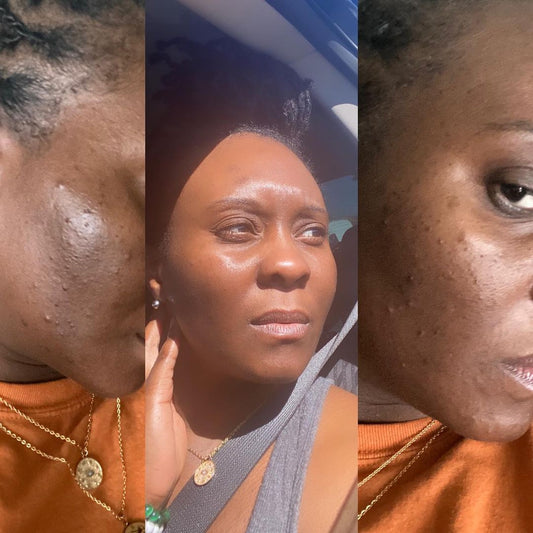 Hembes turmeric skincare products. How to clear skin. Turmeric Skincare. Full skincare set. Skincare routine set. Skincare collection. Face moisturizer. Face wash. Turmeric serum. face cream.Natural skincare products. How to treat acne. How to get rid of dark spots. Dark spots. Acne spots. Pimples. Skincare routine. Glowing skin. Healthy skin. Sensitive skin. Reduce fine lines. Reduce wrinkles. Even skin. Hydrate skin. Nourish skin. Dry skin. Oily skin. Combination skin. Anti-aging skincare